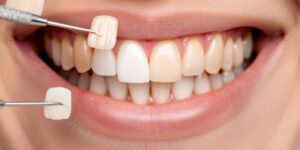 Close-up of a patient’s smile during a veneer fitting, showing color comparison tools against natural teeth at 92 Dentistry in Portland, OR.