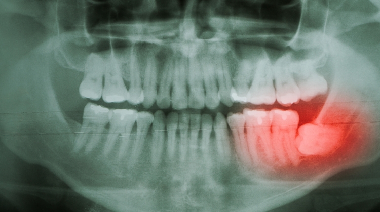 Dental X-ray showing impacted lower right wisdom tooth highlighted in red at 92 Dentistry in Portland, OR.
