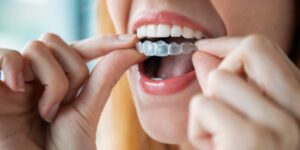 Woman inserting clear Invisalign aligners | 92 Dentistry, Portland, OR