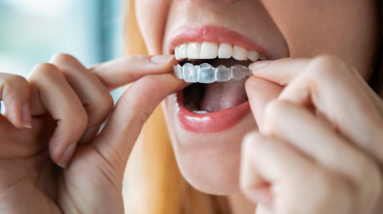 Woman inserting clear Invisalign aligners | 92 Dentistry, Portland, OR