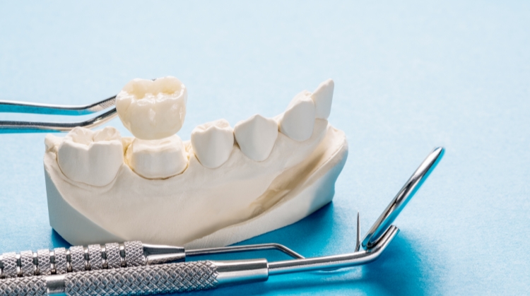 Dental crown model with tools at 92 Dentistry, Portland, OR.
