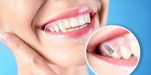 Close-up of a smiling woman with a dental implant illustration, highlighting tooth restoration by 92 Dentistry in Portland, OR.
