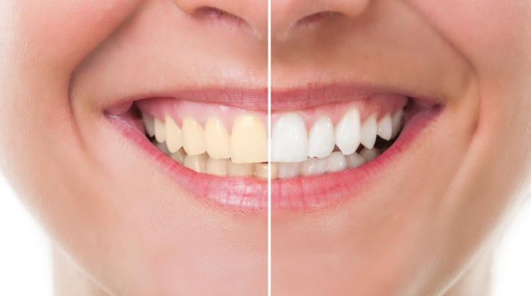 Before and after comparison of a patient's smile showing the results of professional teeth whitening at 92 Dentistry in Portland, OR — left side shows stained teeth, right side shows bright, white teeth.