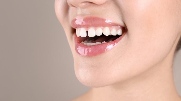 Close-up of a smiling woman showing gaps between her front teeth – 92 Dentistry, Portland, OR