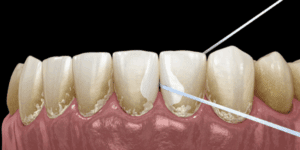 Close-up of teeth with plaque buildup being flossed at 92 Dentistry in Portland, OR.