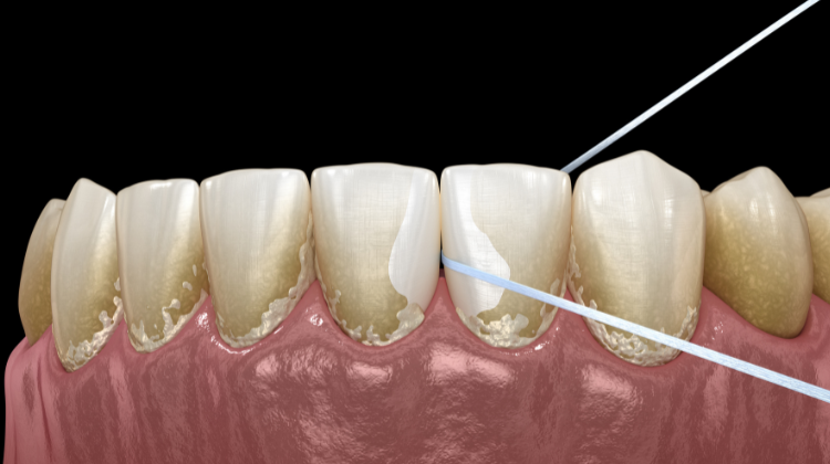 Close-up of teeth with plaque buildup being flossed at 92 Dentistry in Portland, OR.