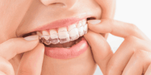 Close-up of a person placing a SureSmile clear aligner on their teeth at 92 Dentistry in Portland, OR.