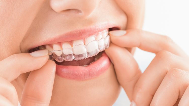 Close-up of a person placing a SureSmile clear aligner on their teeth at 92 Dentistry in Portland, OR.